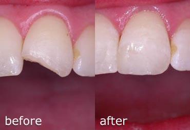 Composite Repair