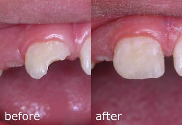 Composite repair