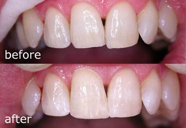 Composite restoration