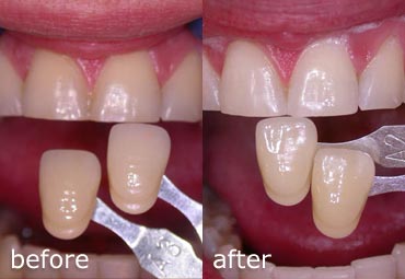 Before and after teeth whitening