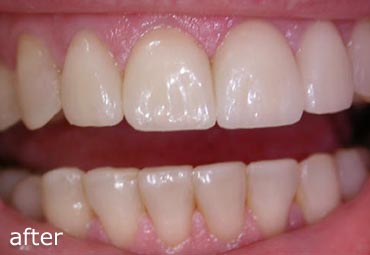 After treatment with veneers