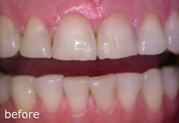 Before treatment with veneers