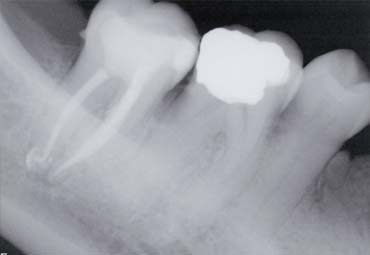 Before and after treatment with bridges