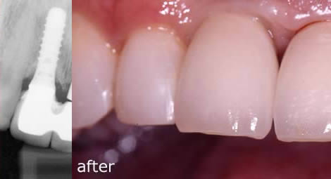Before and after treatment with bridges