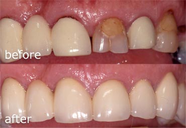 Before and after treatment with bridges