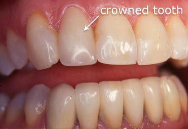 Crowned Tooth