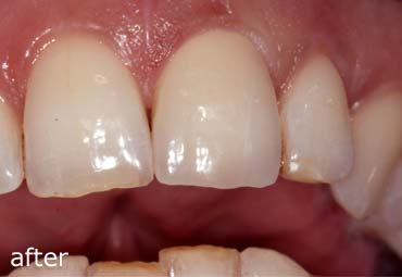 After Crowns Treatment
