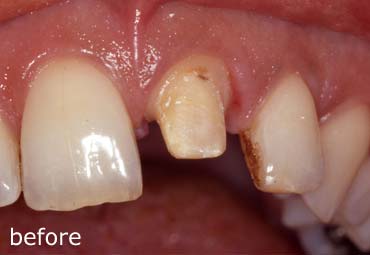 Before Crowns Treatment