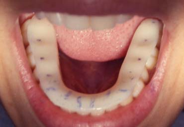 Before Crowns Treatment