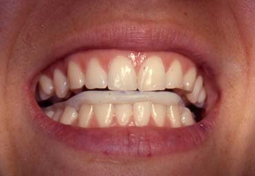 After Crowns Treatment
