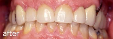 After Treatment