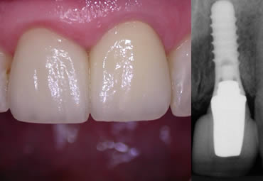Before and after treatment with bridges