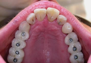 Before and after treatment with bridges