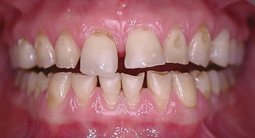 Before Composite Treatment