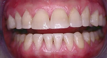 After Composite Treatment