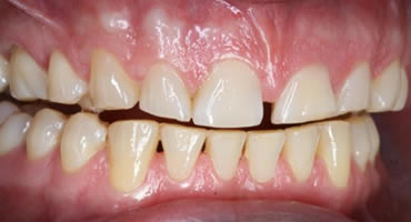 Before Composite Treatment