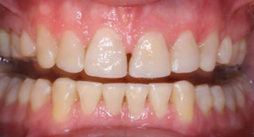 After Composite Treatment