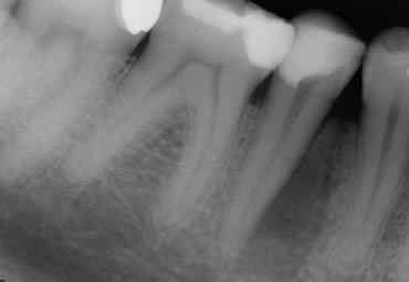 Before Crowns Treatment