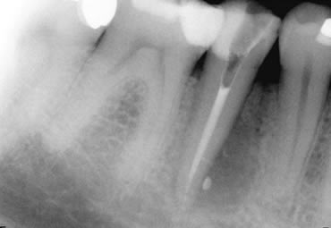 After Crowns Treatment