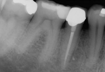 Crowned Tooth