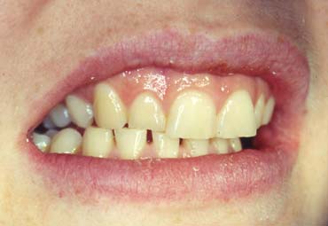 Crowned Tooth