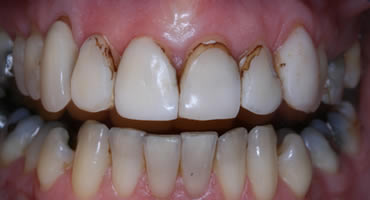Before treatment with veneers