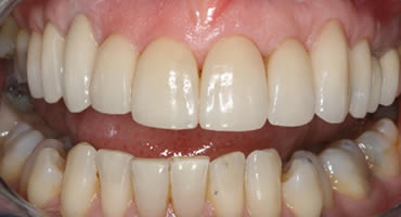 After treatment with veneers