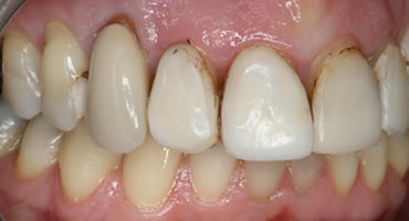 Before treatment with veneers
