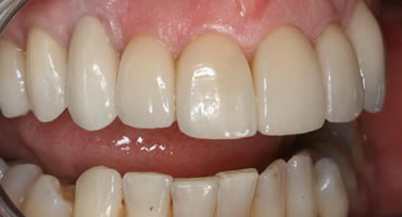 After treatment with veneers